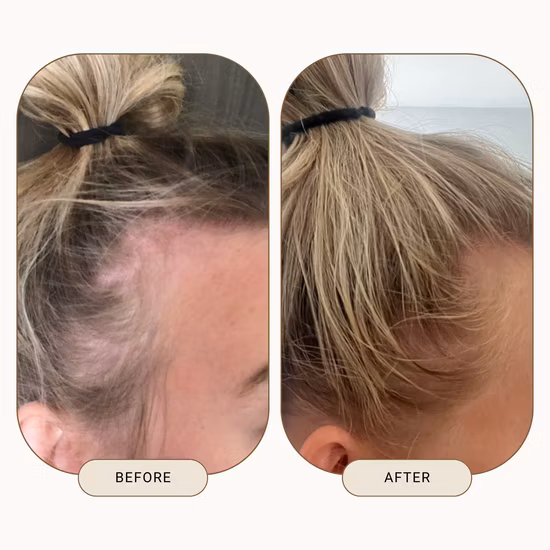 Aceite de romero para el cuidado del cuero cabelludo y el crecimiento reparador orgánico natural para el crecimiento del cabello